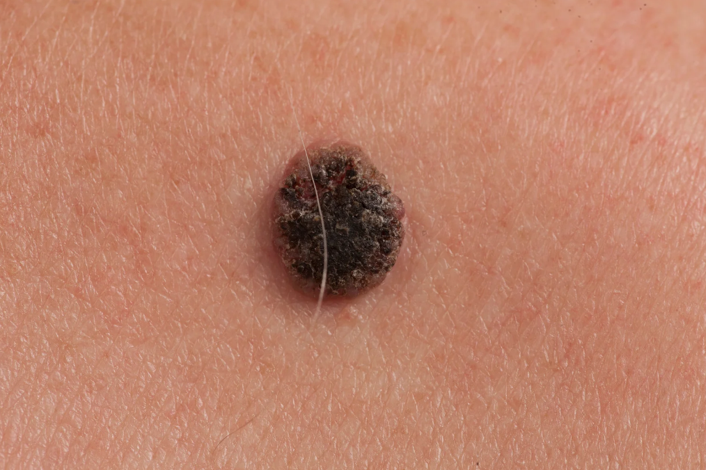 Hudkreft: Symptomer, typer og hvordan du kan forebygge