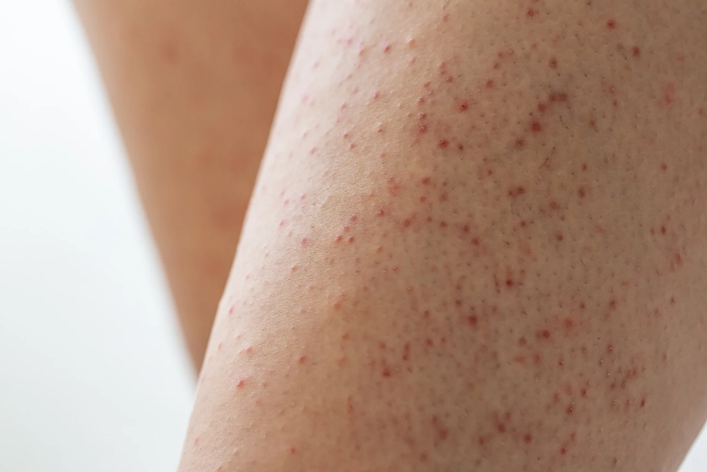 keratosis pilaris