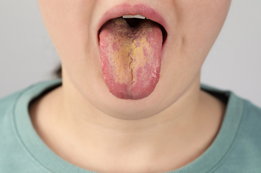 Sopp i munnen: Symptomer, årsaker og behandling av trøske